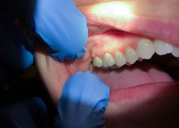 Best Knocked-Out Tooth Emergency  in Elverta, CA